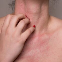 Allergia al nichel: sintomi, cura e alimenti da evitare
