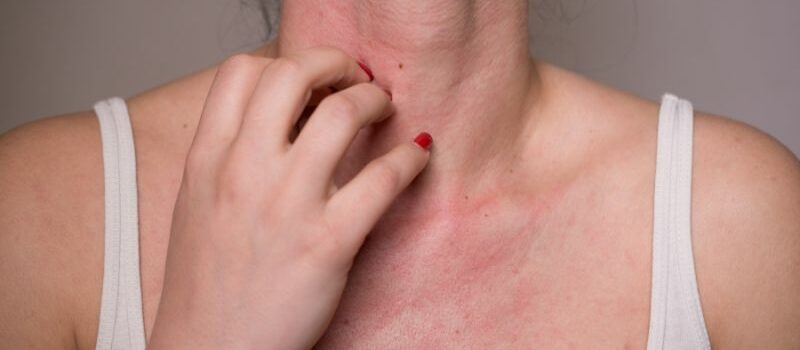 Allergia al nichel: sintomi, cura e alimenti da evitare